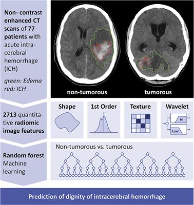 Neoplastic and Non-neoplastic Acute Intracerebral Hemorrhage in CT Brain Scans: Machine Learning-Based Prediction Using Radiomic Image Features